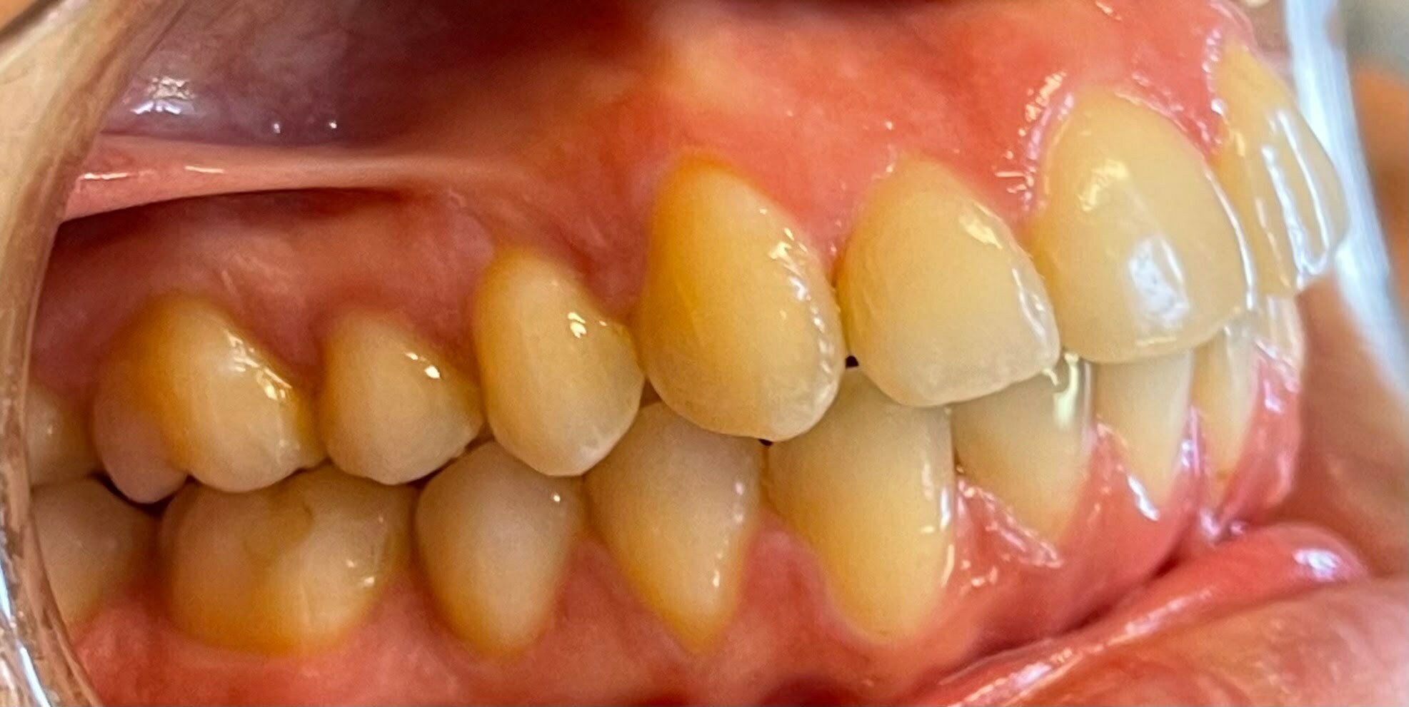 teeth whitening