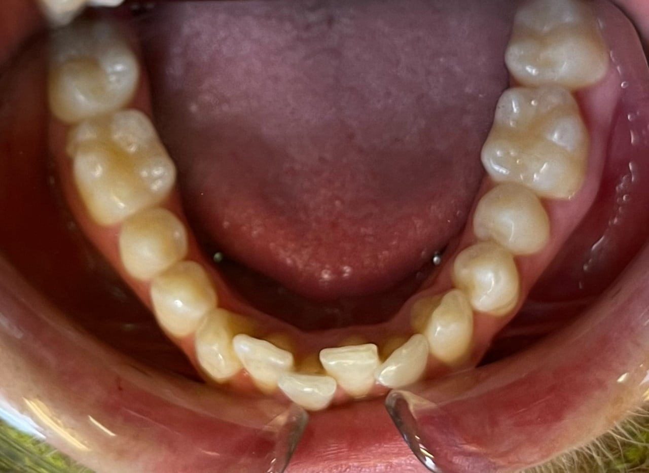 teeth whitening