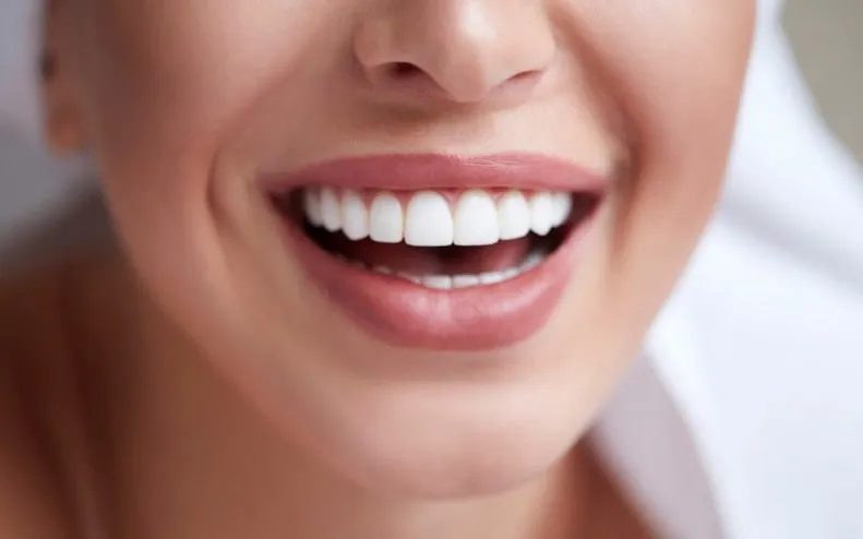 Porcelain Veneers Porcelain Veneers