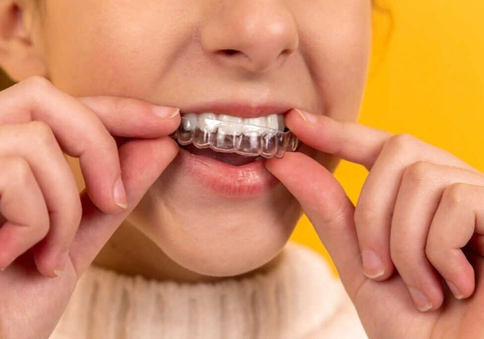Teeth straightening without metal braces
