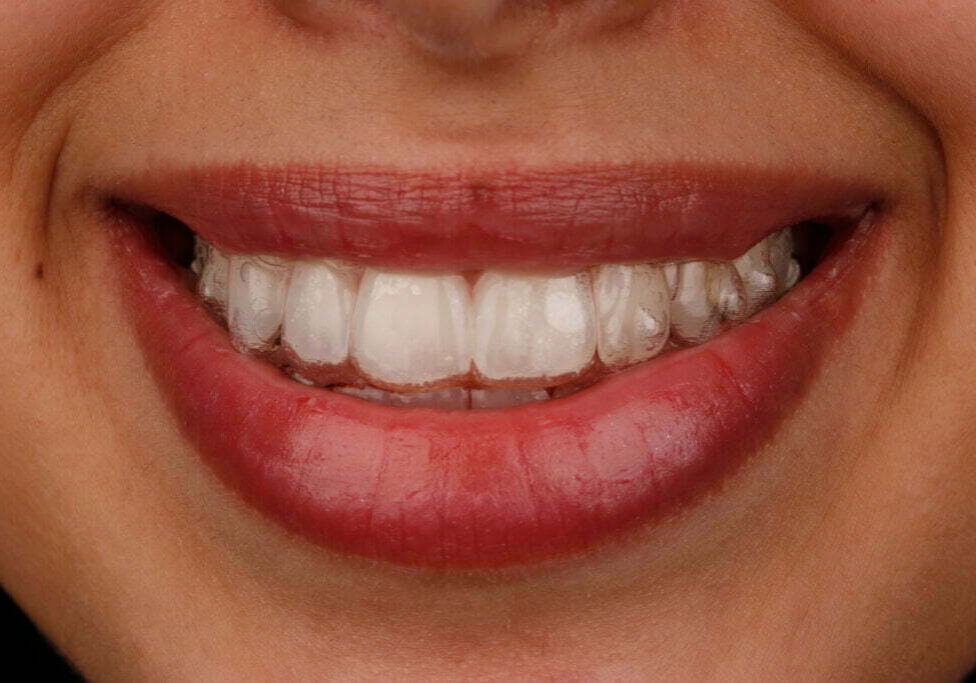 teeth whitening price in melbourne