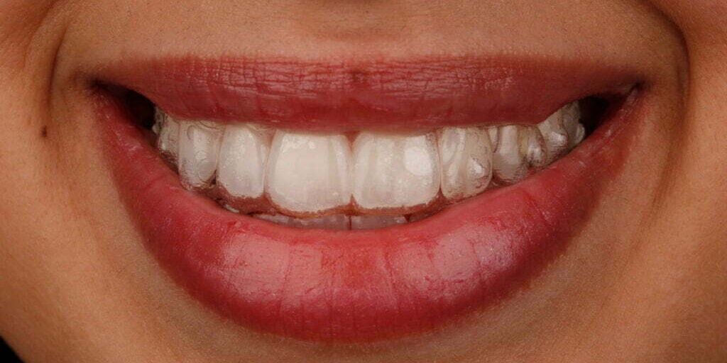 teeth whitening price in melbourne